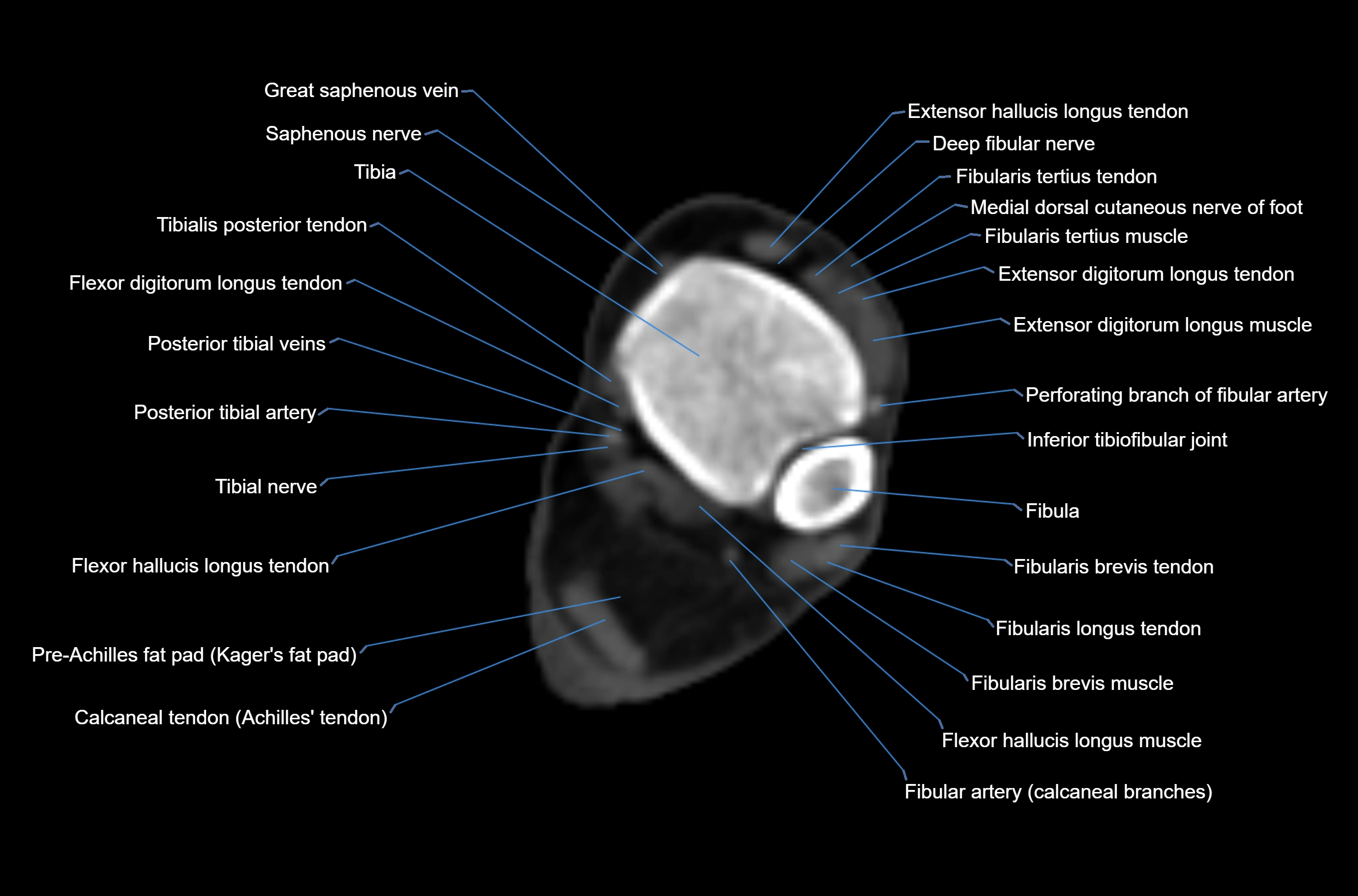CT Ankle axial cross sectional anatomy labelled image -00025.webp